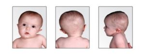 Кривошея у новорожденных. признаки, фото, симптомы и лечение
