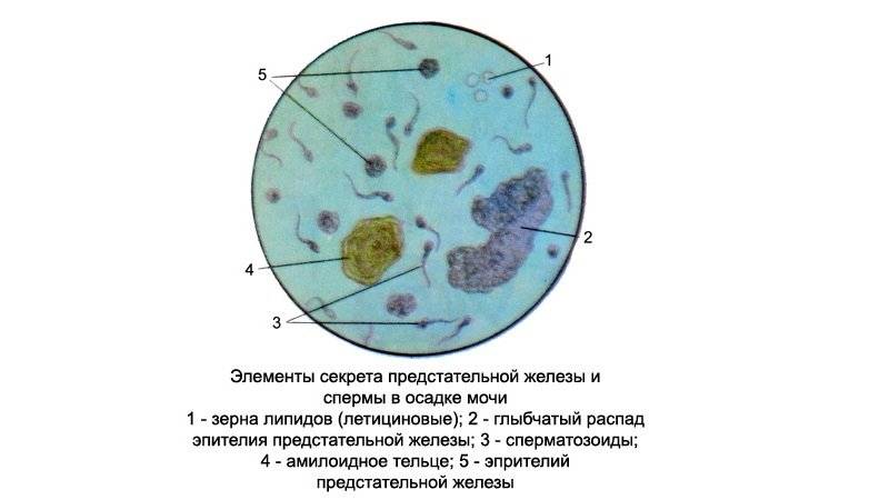 Эритроциты, лецитиновые зерна и эпителиальные клетки в спермограмме