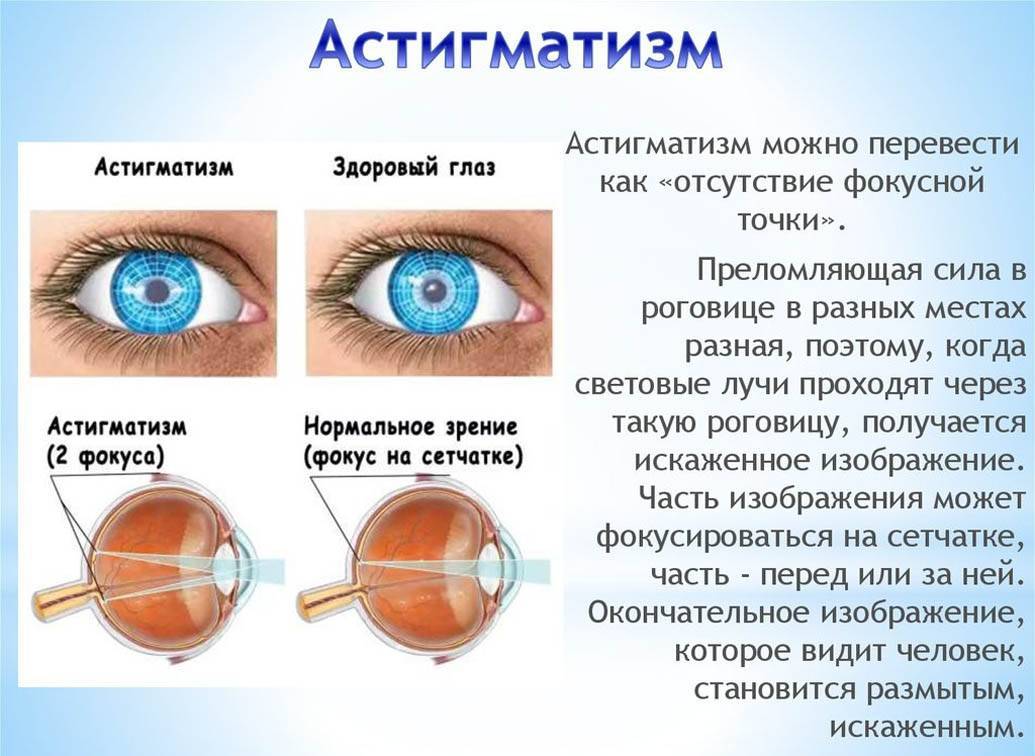 Амблиопия у ребенка: синдром ленивого глаза