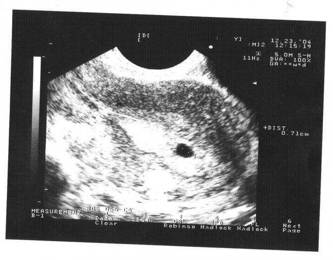 Узи на 1, 2, 3 неделе беременности; покажет ли узи, фото