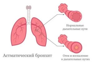 Аллергический бронхит: симптомы и лечение у детей разного возраста | konstruktor-diety.ru