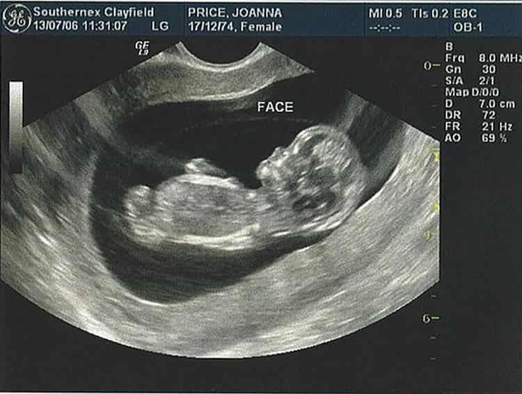 11 неделя беременности: что происходит с малышом и мамой, ощущения, развитие плода -видео и фото