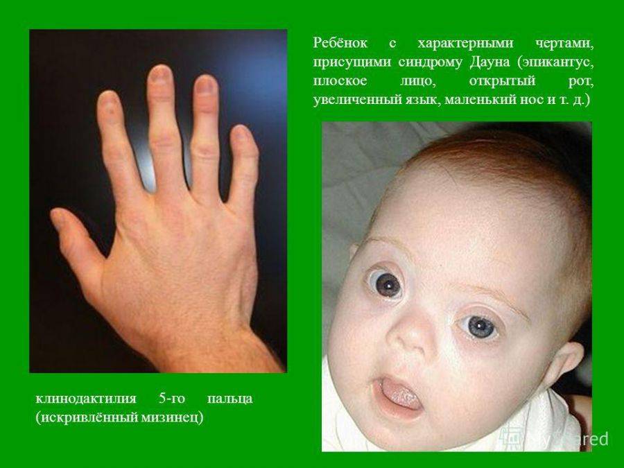 Признаки синдрома дауна у новорожденных: как определить болезнь, симптомы