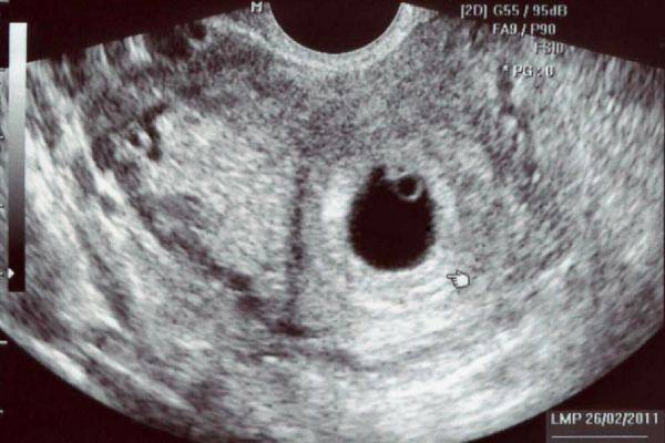На какой неделе видно эмбрион на узи? на каком сроке виден плод?