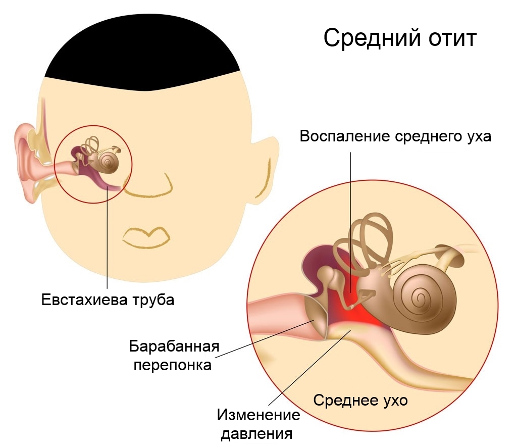 Как понять по симптомам, что у грудничка болит ухо