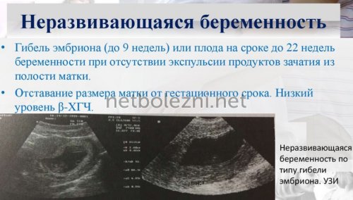 Причины замершей беременности: почему происходит замерание плода на ранних сроках / mama66.ru