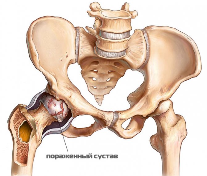Первичные симптомы артрита тазобедренного сустава и его лечение