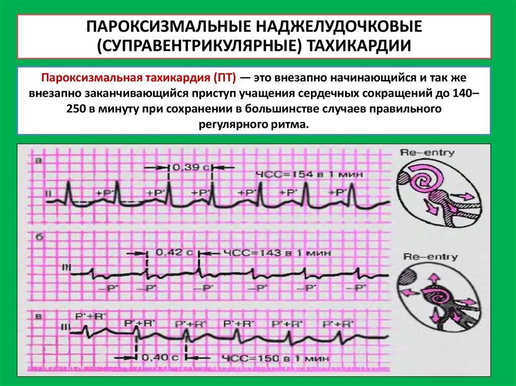 Синусовая аритмия сердца у ребенка