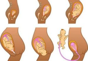 Признаки неправильного положения плода при беременности - как изменить положение ребенка в матке