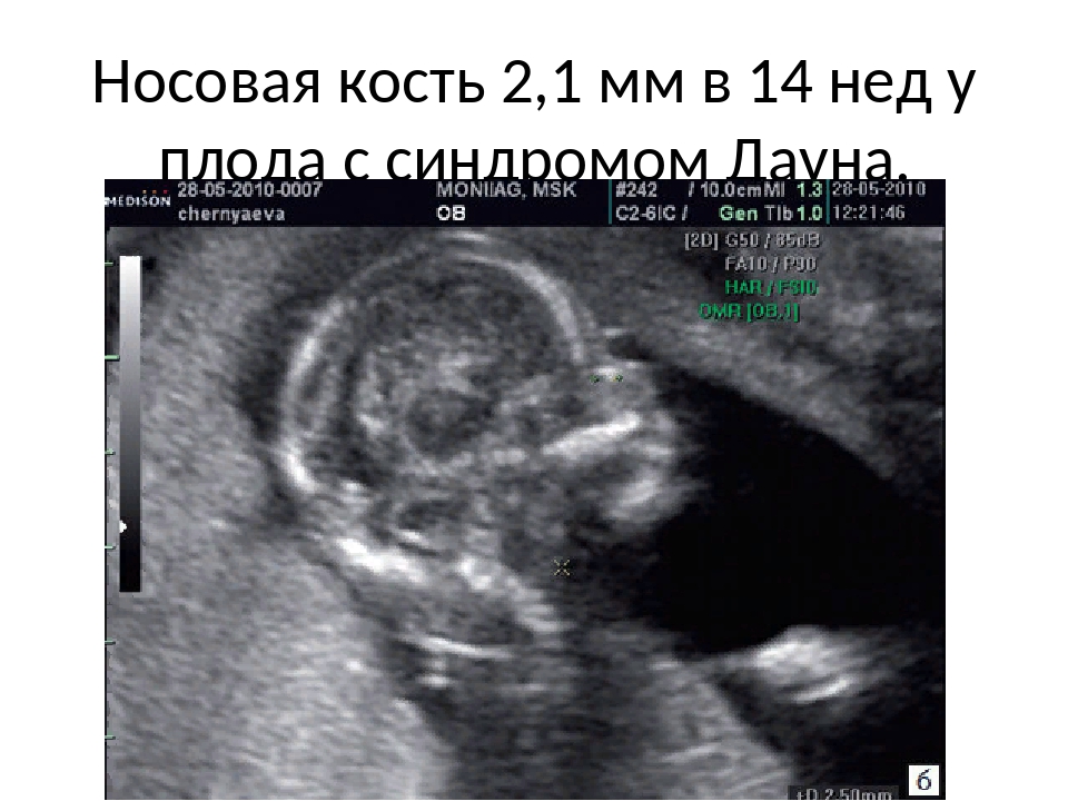 Гипоплазия костей носа плода 19 недель - беременная