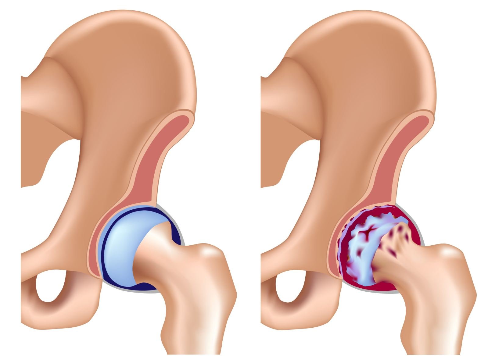 Симптомы и лечение артрита тазобедренного сустава