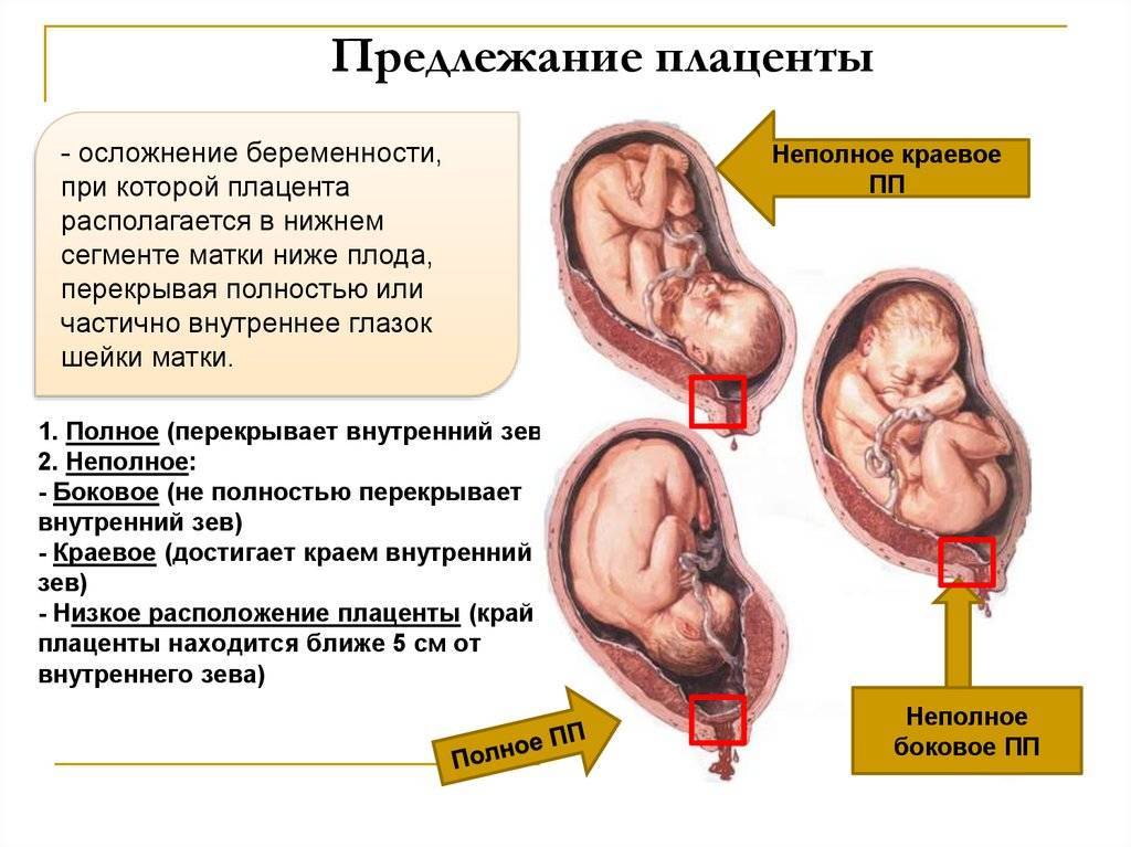 Центральное предлежание плаценты при беременности: что характерно для центрального расположения хориона, особенность неполной формы