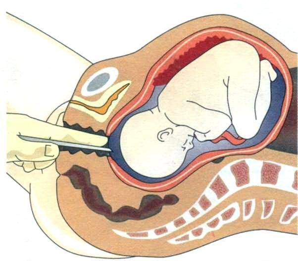 Катетер фолея для стимуляции родов: показания, размеры, применение