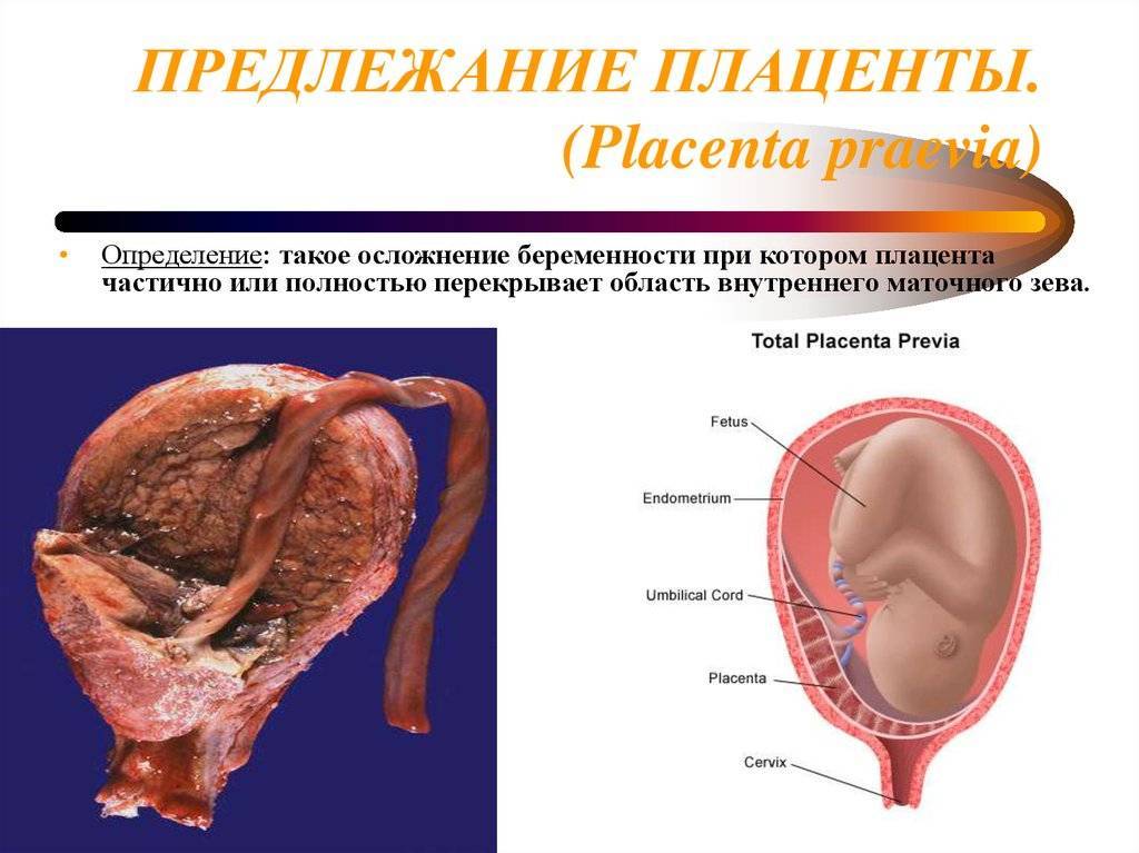 Что такое предлежание плаценты и как оно влияет на беременность и роды?