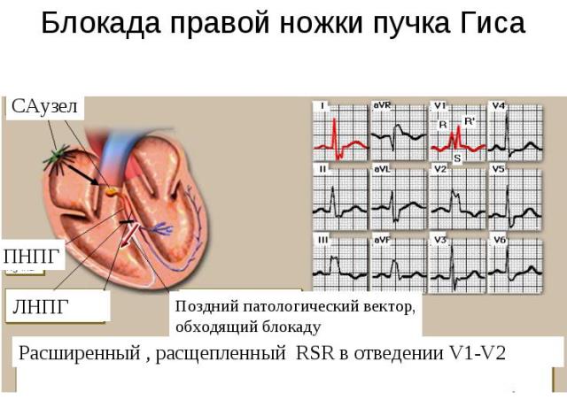 Блокада правой ножки пучка гиса на экг фото