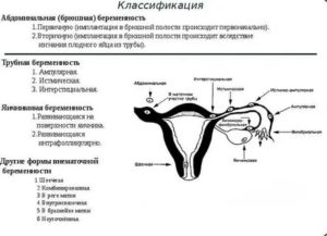Можно ли забеременеть при эндометриозе матки: возможно ли зачать и родить ребенка + отзывы женщин, как протекает беременность