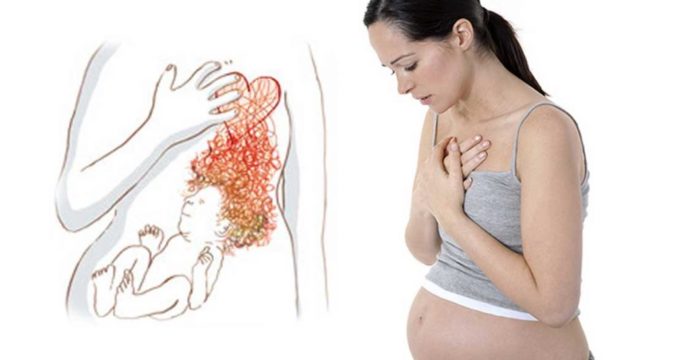 Изжога при беременности как избавиться - развитие ребенка