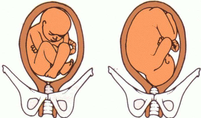 Признаки неправильного положения плода при беременности - как изменить положение ребенка в матке