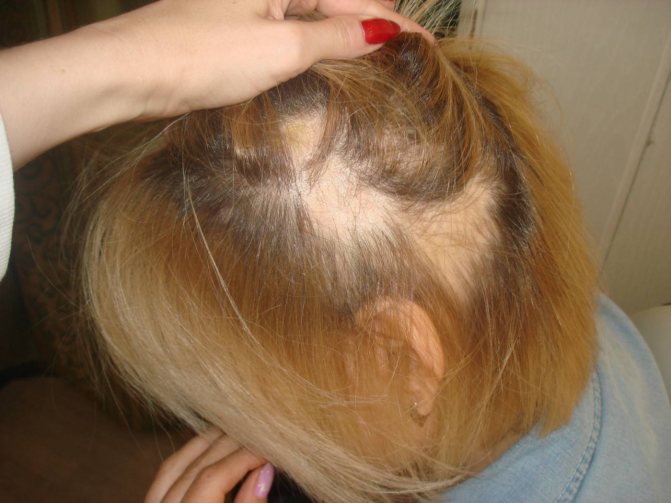 С чем связано выпадение волос у ребенка? безопасное лечение и подходящие щадящие средства