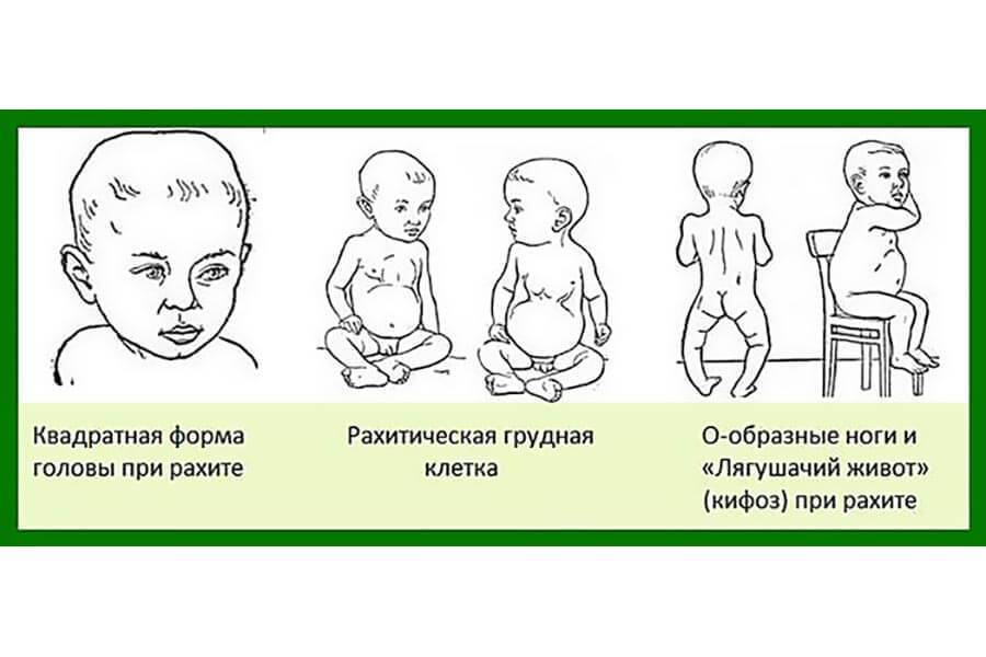 Симптомы и первые признаки рахита у грудничков (46 фото): что это такое, лечение и профилактика у детей до 1 года и новорожденных, 1 и 2 степень