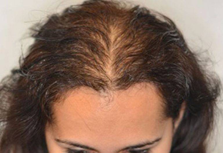 Причины выпадения волос после родов