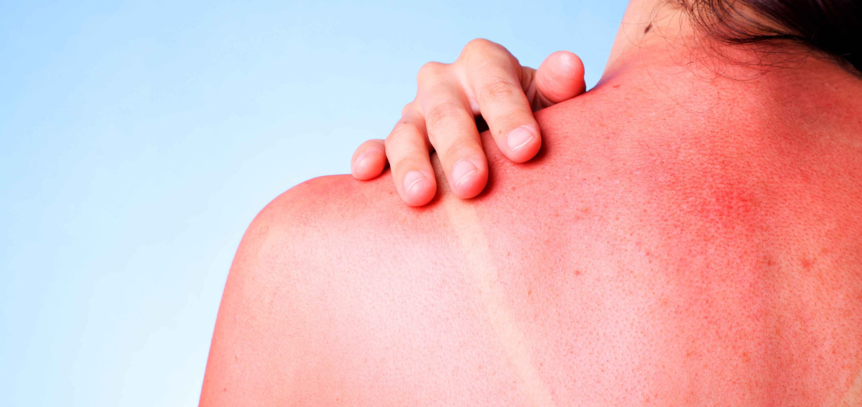 Признаки аллергии на солнце у ребенка и что с ней делать