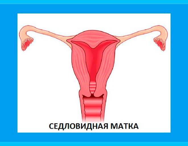 Седловидная матка и беременность: что это за патология и можно ли при ней забеременеть