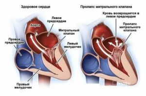 Все о пролапсе клапанов сердца и их лечении