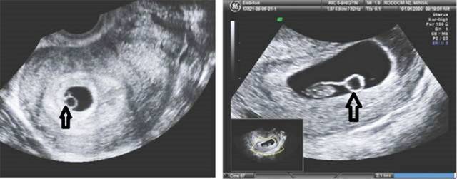 Не виден эмбрион на 5-6 неделе беременности