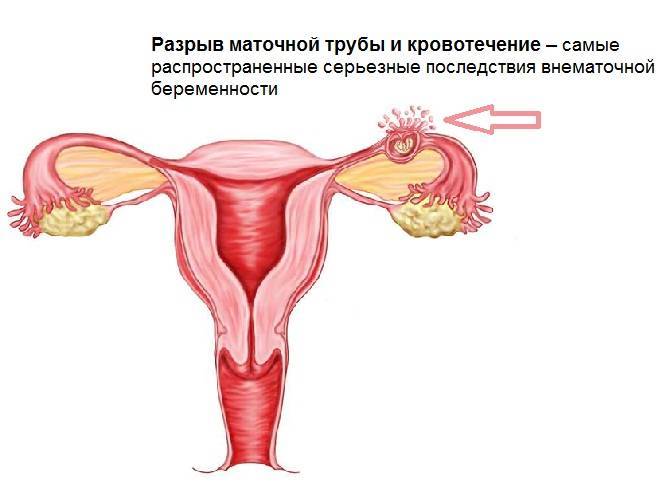Спайки в матке (синдром ашермана): методы удаления, возможность зачатия, симптомы