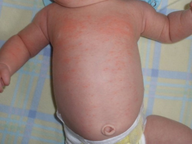 Аллергия пятна на теле у ребенка фото с описанием