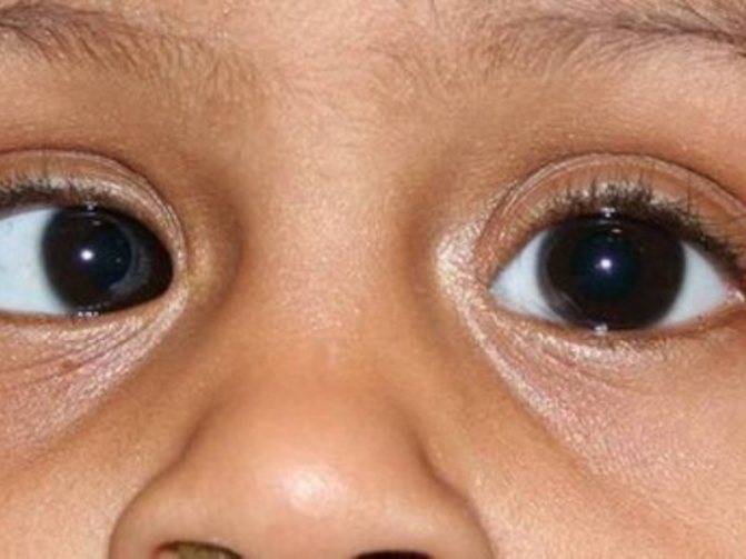 Чем отличается амблиопия разных степеней и как лечить синдром ленивого глаза на разных этапах?