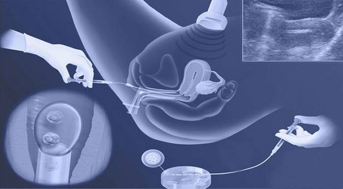 Успешная подсадка эмбрионов, эндометрий и окно имплантации