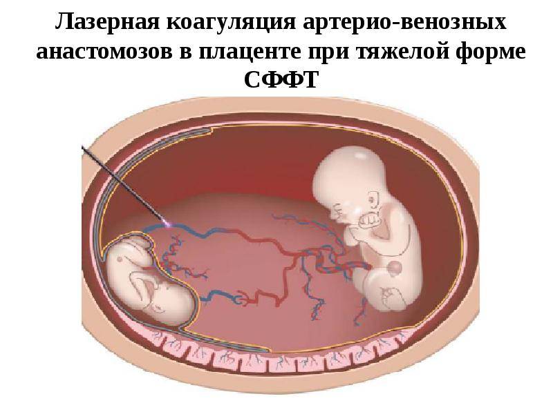 Многоплодная беременность: причины и признаки, ведение и ролы