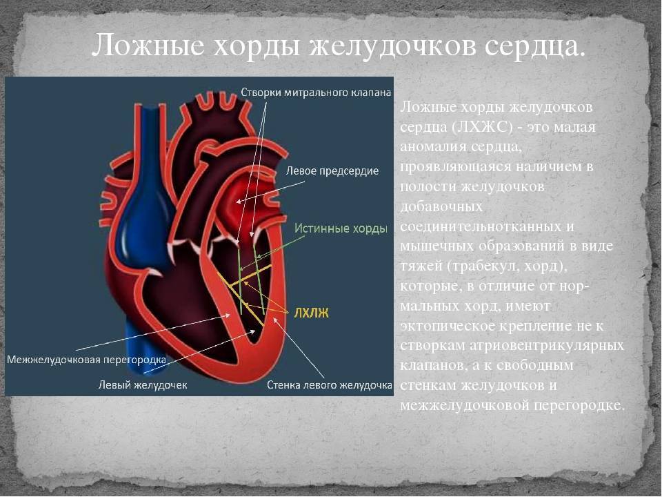 Дополнительная хорда в сердце у ребенка: виды хорд, диагностика и лечение