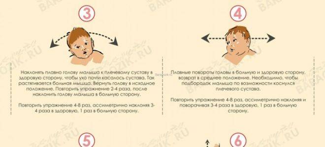 Кривошея у грудничков и новорожденных: признаки у ребёнка, симптомы и лечение, фото
