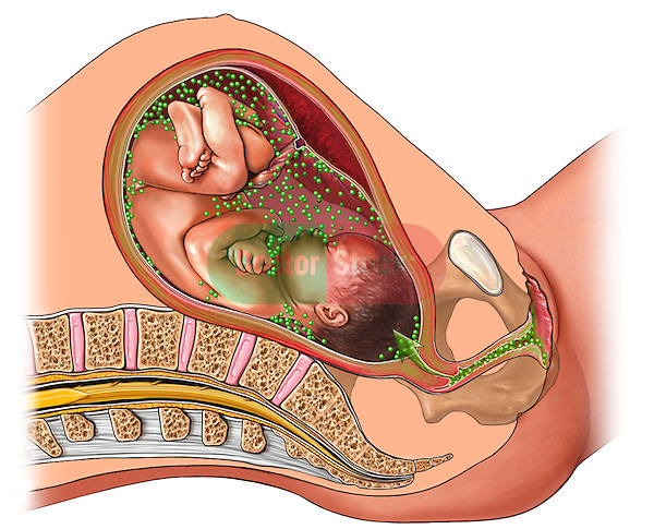 Трихомониаз при беременности: симптомы и осложнения, как лечить