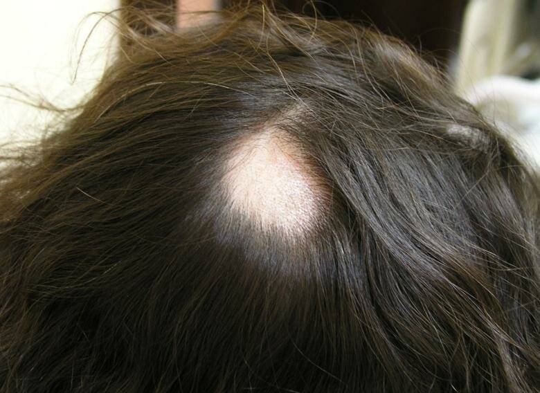 Алопеция у детей: что это такое? 34 фото почему выпадают волосы? лечение выпадения волос, очаговая и гнездная алопеция