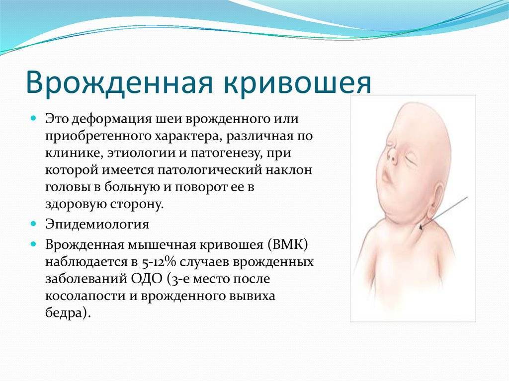 Кривошея у новорожденных - признаки и фото