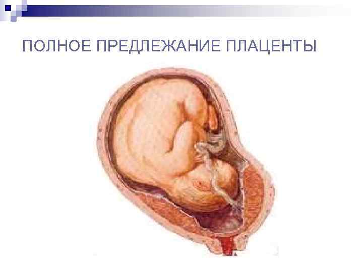 Краевое предлежание хориона: что это, положение плаценты по передней стенке матки, как влияет на плод и может ли перейти в другое положение