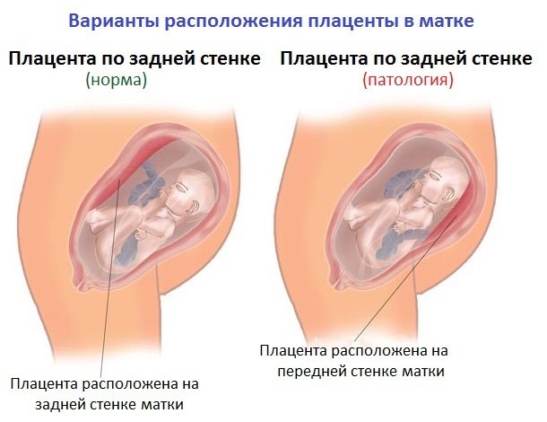 Плацента по передней стенке (21 фото): что значит расположение по передней стенке матки, краевой предлежание и другие виды локализации