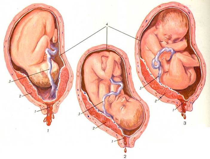 Заключение узи: плацента расположена по передней стенке матки