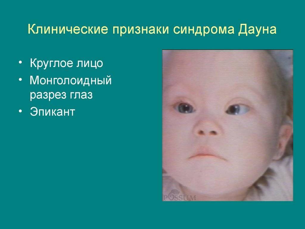 Ребенок с синдромом дауна (59 фото): признаки, какой получают уровень образования, причины у новорожденного, сколько живут и могут ли родиться здоровые дети