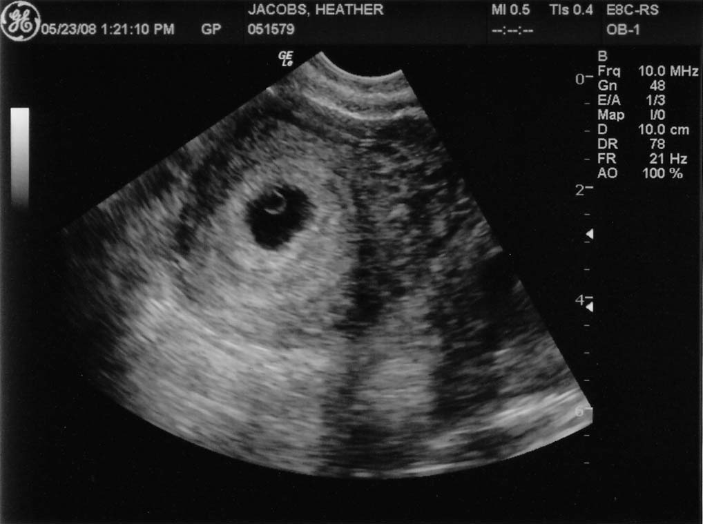 На какой неделе на узи видно эмбрион?