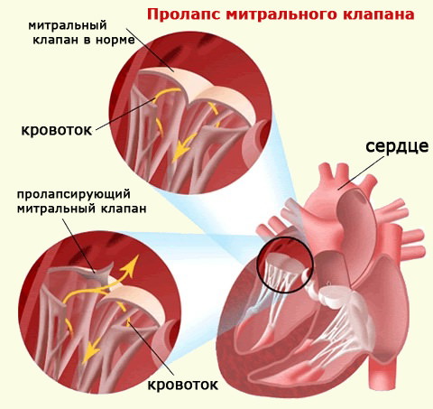 Пролабирование сердечных клапанов – норма или патология? Разбираемся с детским кардиологом