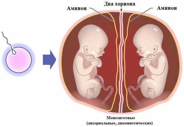 Редукция плода — риски многоплодной беременности