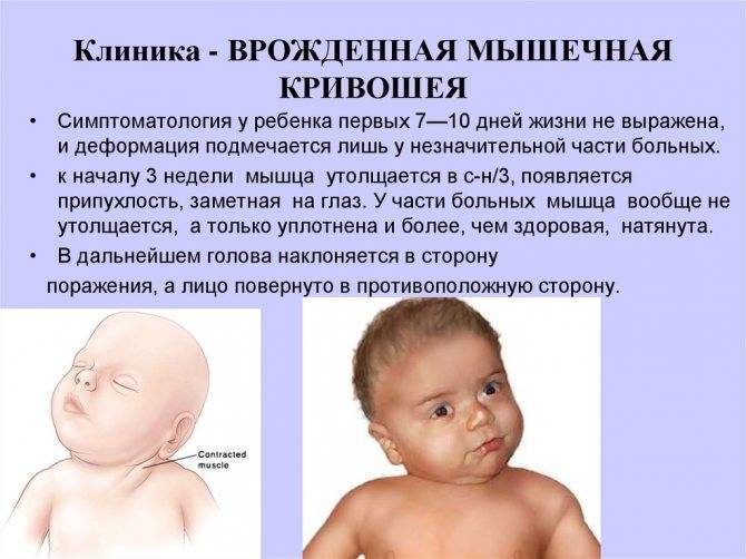 Кривошея у новорожденных: причины возникновения, симптомы у младенцев, массаж и другие методы как лечить