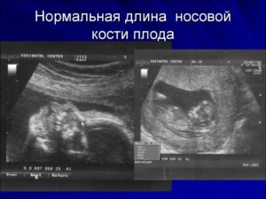 Гипоплазия костей носа плода 19 недель - беременная