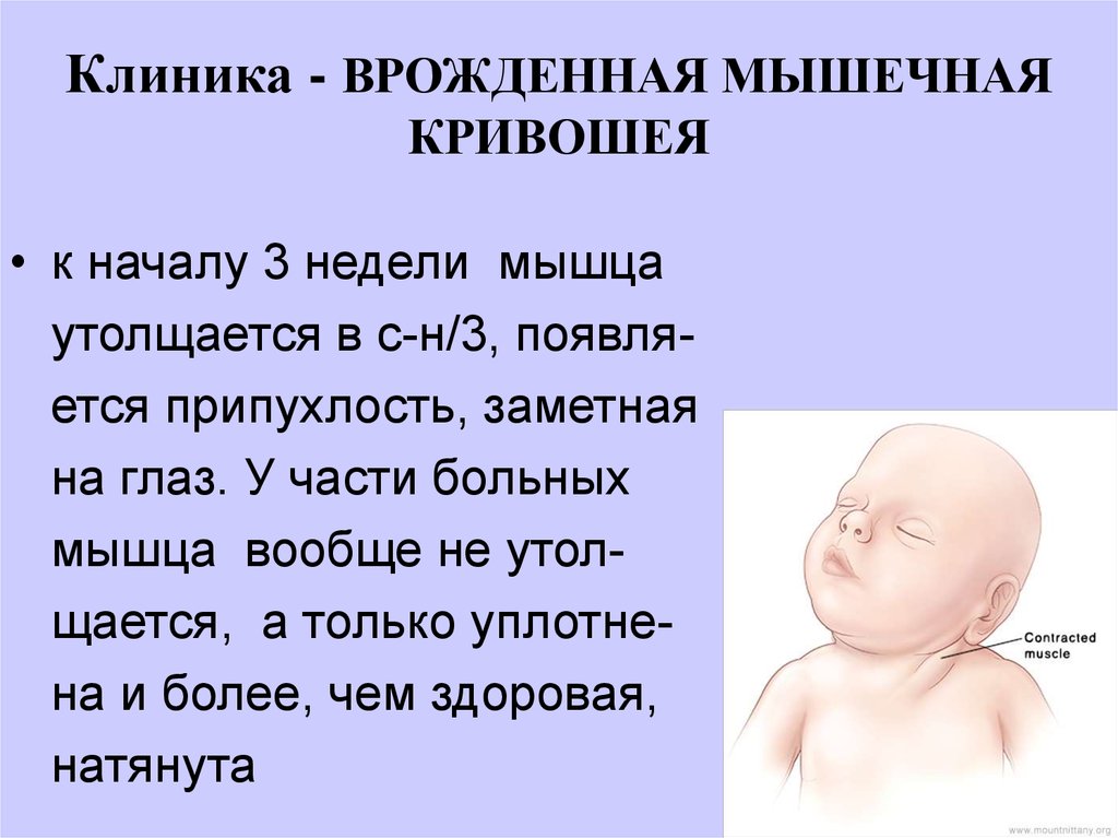 Кривошея у новорожденных: признаки, причины, лечение, массаж, гимнастика