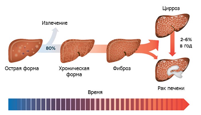 Фиброз простаты фото